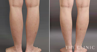 皮下脂肪が比較的多く筋肉量が少ない