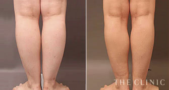 皮下脂肪、筋肉量がともに多い