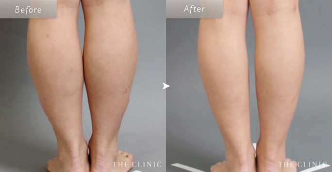 38歳女性(ふくらはぎ)のベイザー脂肪吸引の症例画像