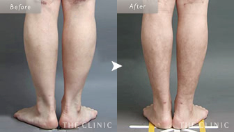 45歳女性(ふくらはぎ)のベイザー脂肪吸引の症例画像