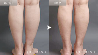 28歳女性(ふくらはぎ)のベイザー脂肪吸引の症例画像
