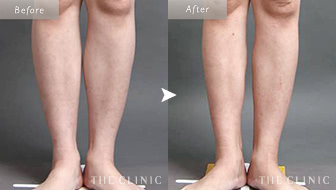 35歳女性(ふくらはぎ)のベイザー脂肪吸引の症例画像