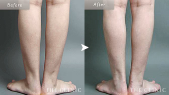 27歳女性(ふくらはぎ)のベイザー脂肪吸引の症例画像