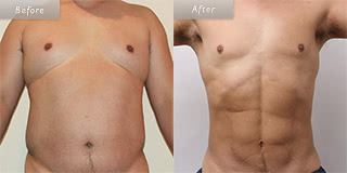 お腹のメンズ脂肪吸引／40代男性