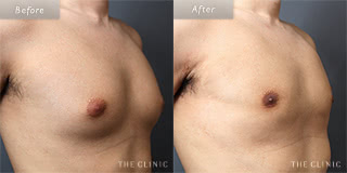 メンズ脂肪吸引の症例（女性化乳房）／20代男性