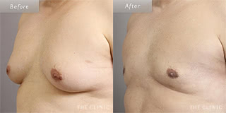 メンズ脂肪吸引の症例（偽性女性化乳房）／40代男性