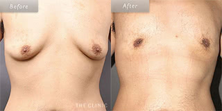 メンズ脂肪吸引の症例（混合型女性化乳房）／30代男性