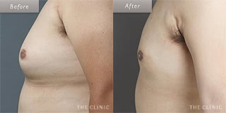 メンズ脂肪吸引の症例（偽性女性化乳房）／30代男性