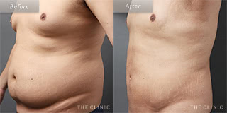 お腹のメンズ脂肪吸引／30代男性