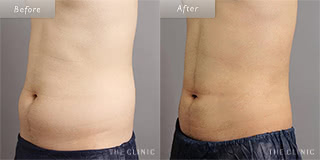 腰・ウエストのメンズ脂肪吸引／20代男性