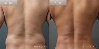 腰・ウエストのメンズ脂肪吸引／40代男性