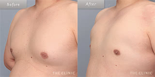 腰・ウエストのメンズ脂肪吸引／30代男性