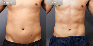 お腹のメンズ脂肪吸引／30代男性