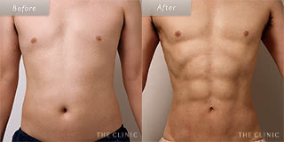 お腹のメンズ脂肪吸引／40代男性