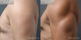 上腕のメンズ脂肪吸引／40代男性