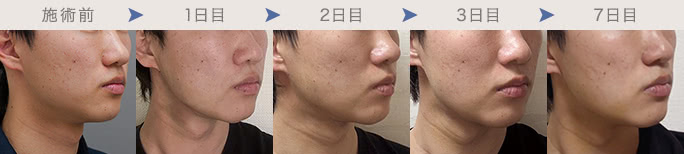 顔のダウンタイム経過の例