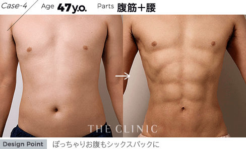 Case-4 Age 47y.o. Parts 腹筋＋腰 | ぽっちゃりお腹もシックスパックに
