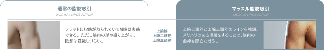 上腕筋・上腕二頭筋・上腕三頭筋 | 通常の脂肪吸引: フラットに脂肪が取られていて細さは実感できる。 ただし筋肉の形や盛り上がり、陰影は認識しづらい。 / マッスル脂肪吸引: 上腕二頭筋と上腕三頭筋のラインを強調。メリハリのある吸引をすることで、筋肉の曲線を際立たせる。