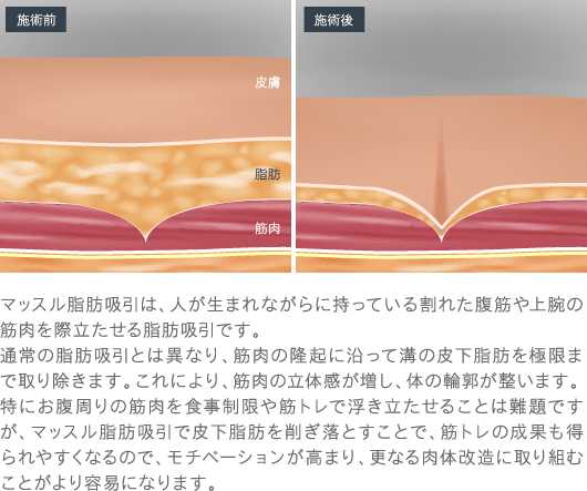 マッスル脂肪吸引は、人が生まれながらに持っている割れた腹筋や上腕の筋肉を際立たせる脂肪吸引です。 通常の脂肪吸引とは異なり、筋肉の隆起に沿って溝の皮下脂肪を極限まで取り除きます。これにより、筋肉の立体感が増し、体の輪郭が整います。 特にお腹周りの筋肉を食事制限や筋トレで浮き立たせることは難題ですが、マッスル脂肪吸引で皮下脂肪を削ぎ落とすことで、筋トレの成果も得られやすくなるので、モチベーションが高まり、更なる肉体改造に取り組むことがより容易になります。