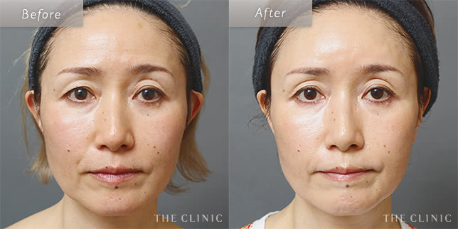 53歳女性のほうれい線への脂肪注入の症例写真