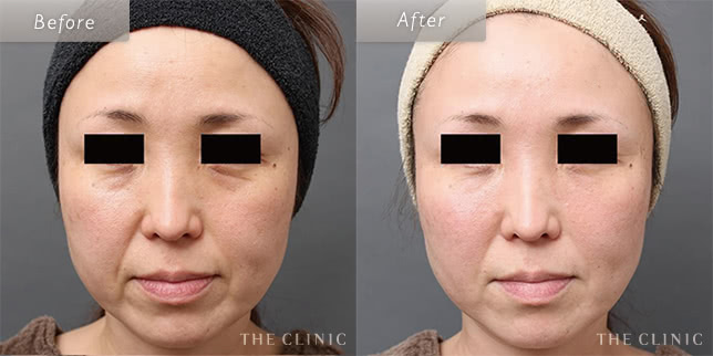 46歳女性のほうれい線への脂肪注入の症例写真