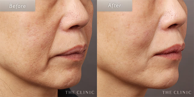 58歳女性のほうれい線への脂肪注入の症例写真