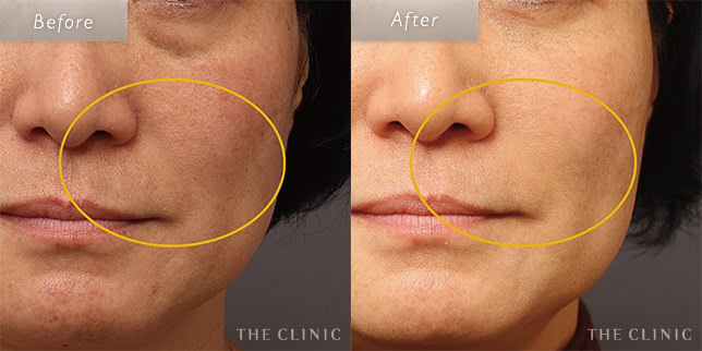 58歳女性のほうれい線への脂肪注入の症例写真