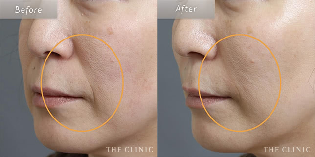 47歳女性のほうれい線への脂肪注入の症例写真