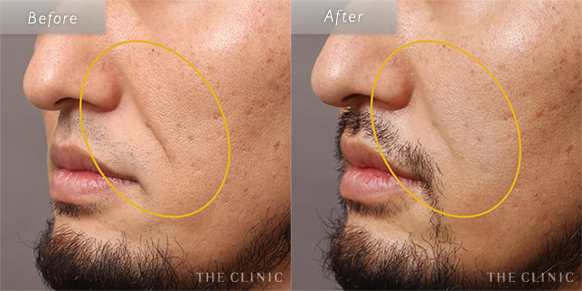 37歳男性のほうれい線への脂肪注入の症例写真