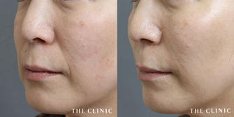 ほうれい線改善のための脂肪注入によるエイジング治療の症例写真