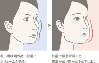 若い頃は頬の高い位置にボリュームがある。 → 加齢で脂肪が減ると、皮膚が余り頬がたるんでしまう。