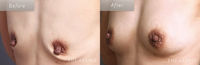 乳頭縮小の（コンデンスリッチ豊胸）の症例画像1