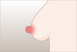 大きさの縮小: 側面の一部を切除して、乳頭の中心を縫合します。 / 高さの縮小: 水平に切除して、乳頭の付け根部分を縫合します。 / 大きさと高さの縮小: 高さと大きさを調整して切除し、切開部分を縫合します。