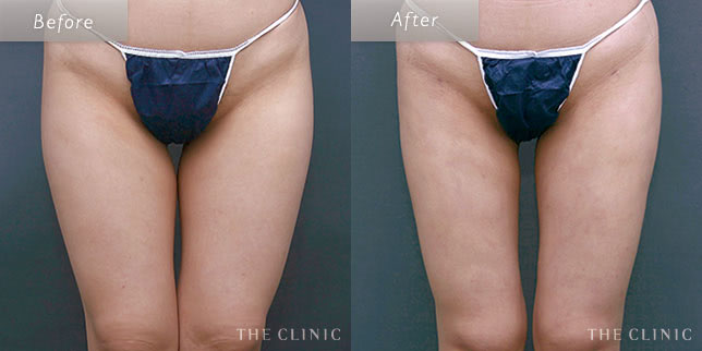 脂肪吸引・痩身 太もも 症例写真
