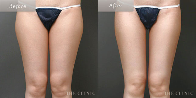 脂肪吸引・痩身 太もも 症例写真