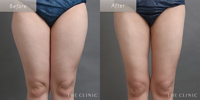 脂肪吸引・痩身 太もも 症例写真