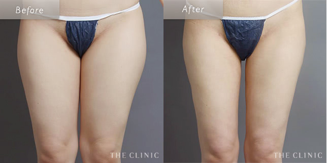 脂肪吸引・痩身 太もも 症例写真