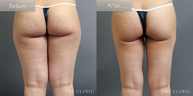 脂肪吸引・痩身 太もも 症例写真