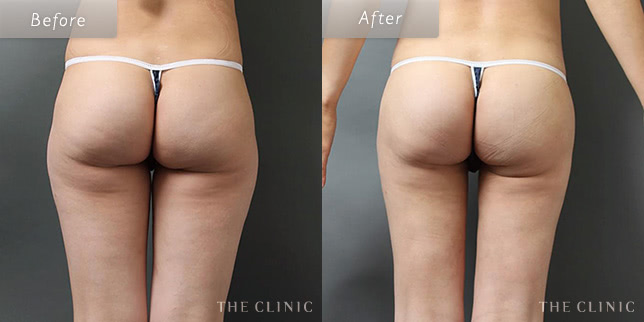 脂肪吸引・痩身 太もも 症例写真