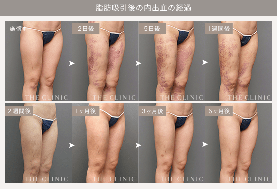 脂肪吸引後の内出血の経過