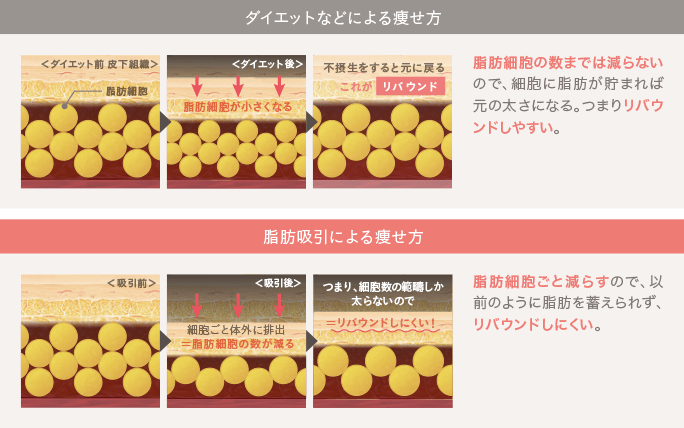 ダイエットがリバウンドする理由／脂肪吸引がリバウンドしない理由