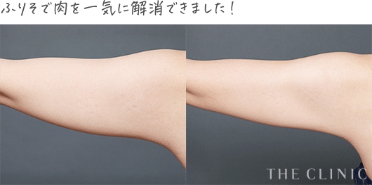 タイトニング脂肪吸引 症例５