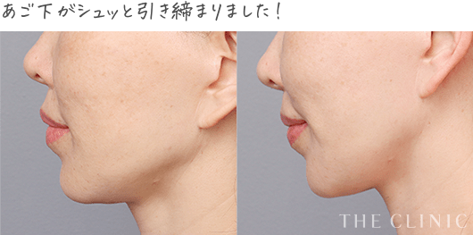 タイトニング脂肪吸引 症例７