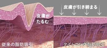 たるみの3大原因すべてに対応