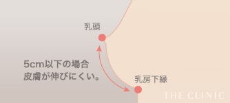 脂肪注入豊胸で定着を左右する皮膚の伸び具合をチェックする目安