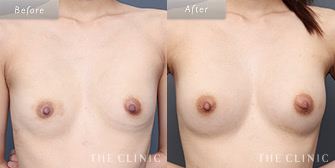 痩せ型の豊胸脂肪注入の(エクソソーム豊胸)の症例画像1