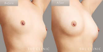 痩せ型の豊胸脂肪注入の(エクソソーム豊胸)の症例画像2