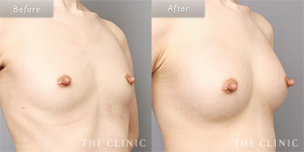 痩せ型の豊胸脂肪注入の(コンデンスビブラ豊胸)の症例画像3