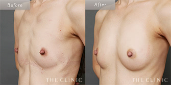 痩せ型の豊胸脂肪注入の(コンデンスビブラ豊胸)の症例画像4