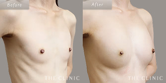 痩せ型の豊胸脂肪注入の(コンデンスビブラ豊胸)の症例画像5